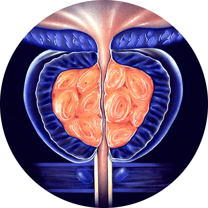 Kronični prostatitis