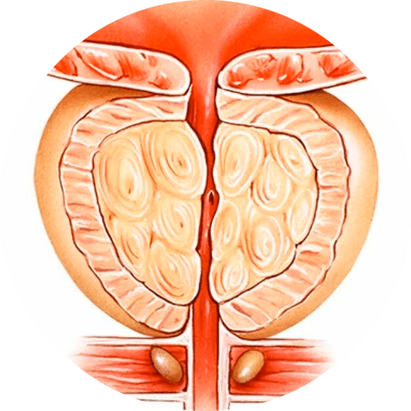Posledice nezdravljenega prostatitisa