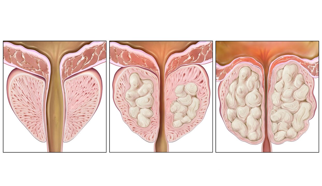 stopnje raka prostate