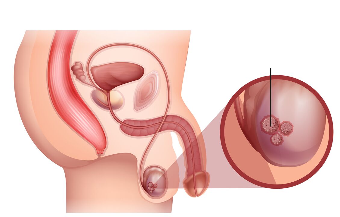 znaki raka prostate