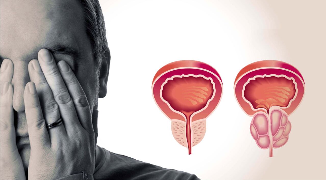 kronični prostatitis pri moških