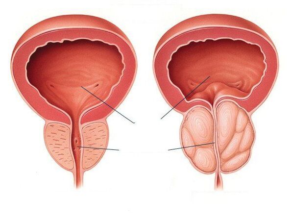 zdrava in bolna prostata